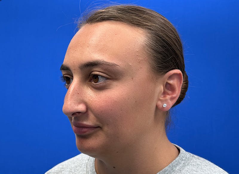 Rhinoplasty Before & After Gallery - Patient 427726 - Image 3