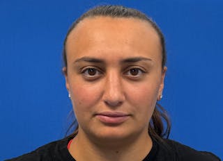 Rhinoplasty Before & After Gallery - Patient 427726 - Image 6