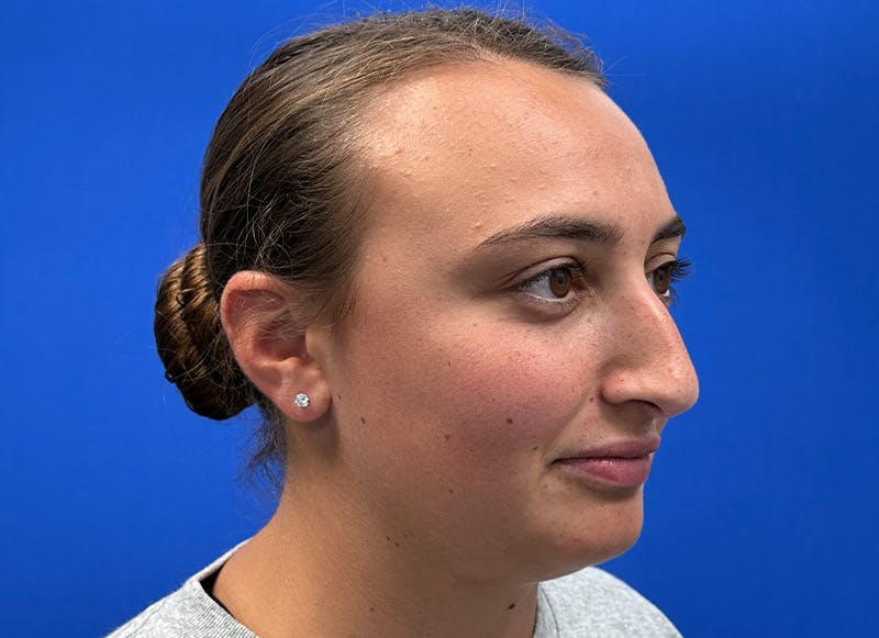 Rhinoplasty Before & After Gallery - Patient 427726 - Image 7