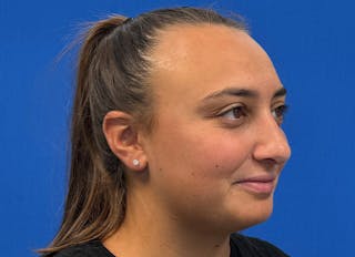 Rhinoplasty Before & After Gallery - Patient 427726 - Image 8