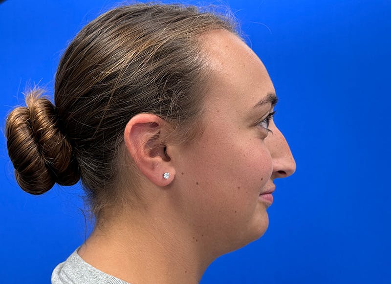 Rhinoplasty Before & After Gallery - Patient 427726 - Image 9