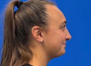 Rhinoplasty Before & After Gallery - Patient 427726 - Image 10