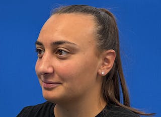 Rhinoplasty Before & After Gallery - Patient 427726 - Image 4