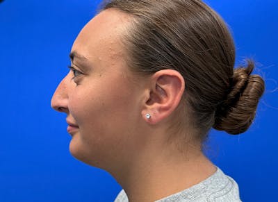 Rhinoplasty Before & After Gallery - Patient 427726 - Image 1