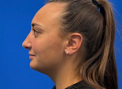 Rhinoplasty Before & After Gallery - Patient 427726 - Image 2