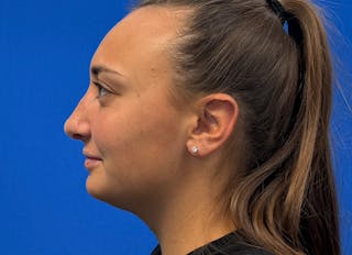 Rhinoplasty Before & After Gallery - Patient 427726 - Image 2
