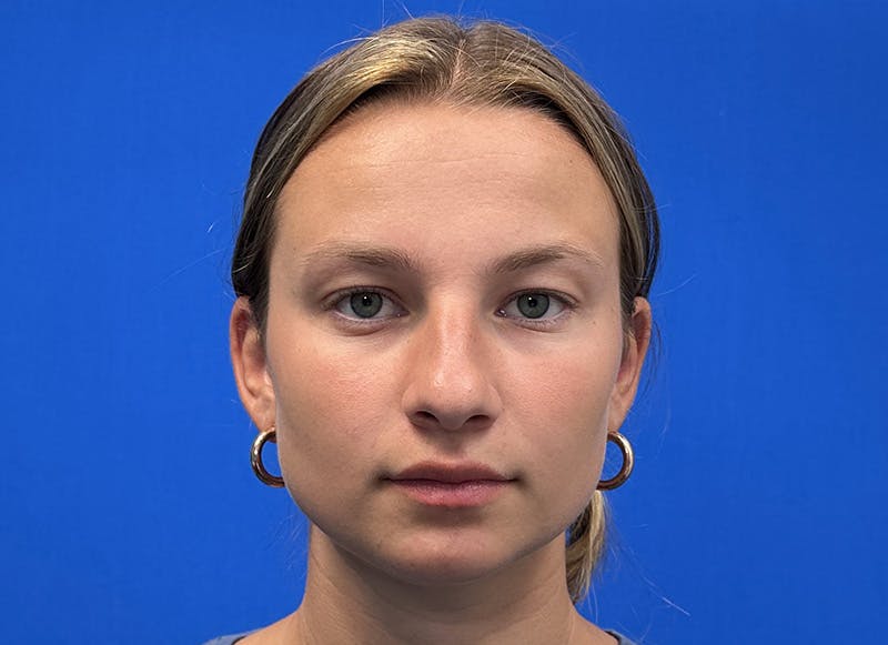 Rhinoplasty Before & After Gallery - Patient 121727056 - Image 5