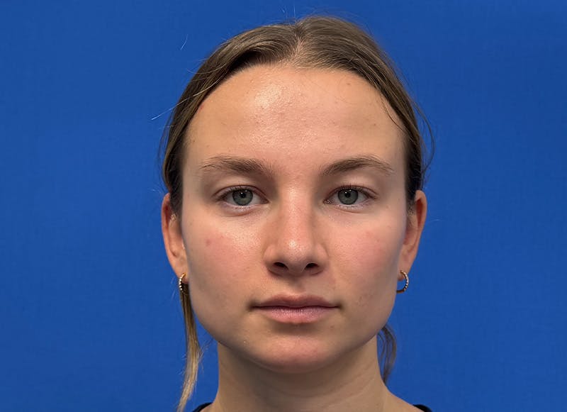Rhinoplasty Before & After Gallery - Patient 121727056 - Image 6