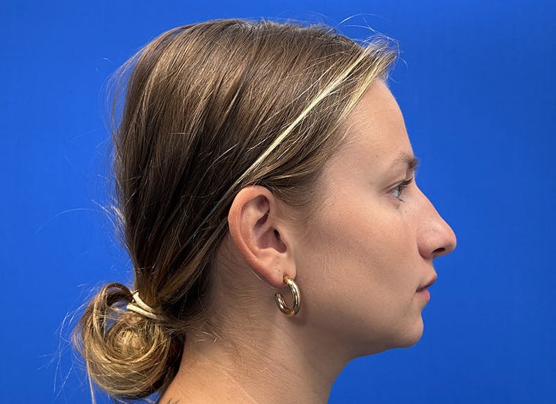 Rhinoplasty Before & After Gallery - Patient 121727056 - Image 9