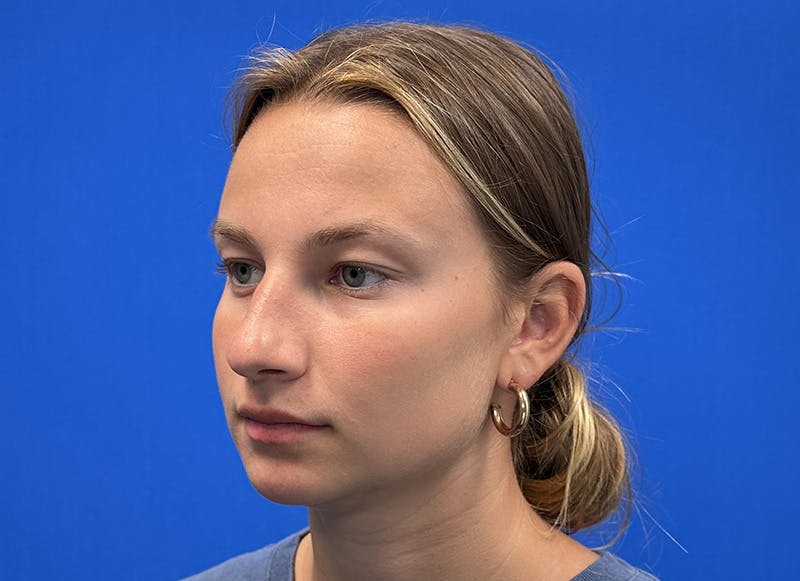 Rhinoplasty Before & After Gallery - Patient 121727056 - Image 3