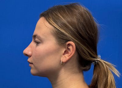 Rhinoplasty Before & After Gallery - Patient 121727056 - Image 2