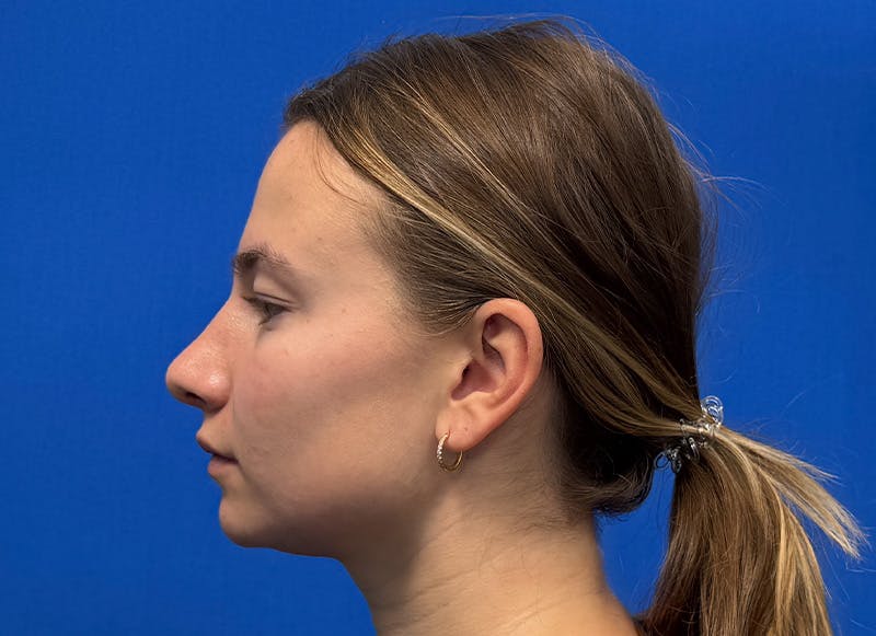 Rhinoplasty Before & After Gallery - Patient 121727056 - Image 2