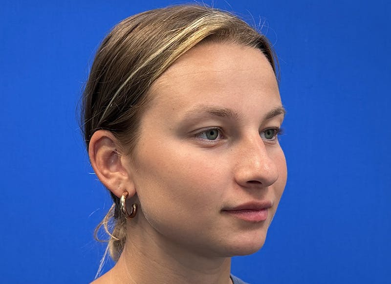Rhinoplasty Before & After Gallery - Patient 121727056 - Image 7