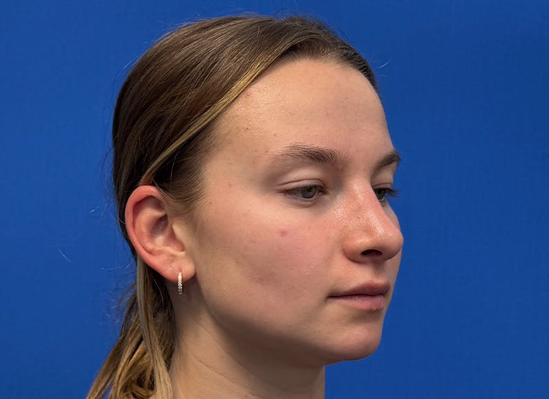 Rhinoplasty Before & After Gallery - Patient 121727056 - Image 8