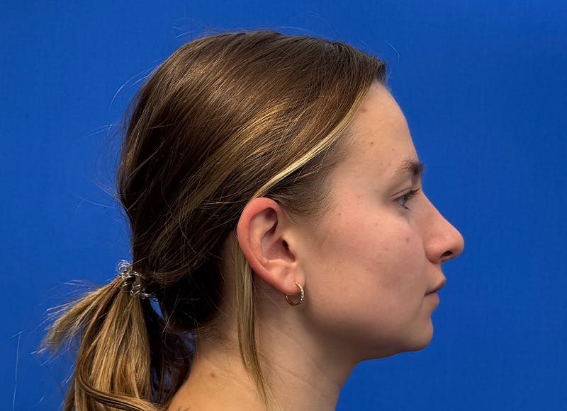 Rhinoplasty Before & After Gallery - Patient 121727056 - Image 10
