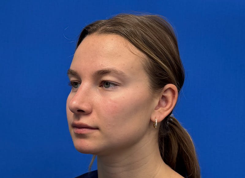Rhinoplasty Before & After Gallery - Patient 121727056 - Image 4