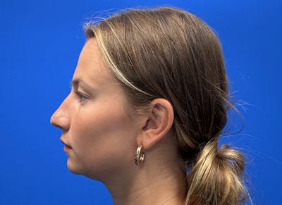 Rhinoplasty Before & After Gallery - Patient 121727056 - Image 1
