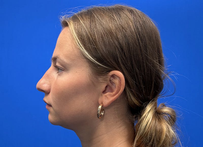Rhinoplasty Before & After Gallery - Patient 121727056 - Image 1
