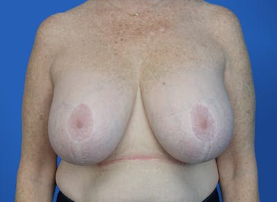 Breast Lift Before & After Gallery - Patient 117765 - Image 5