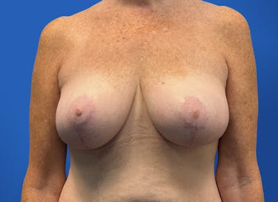 Breast Lift Before & After Gallery - Patient 117765 - Image 6