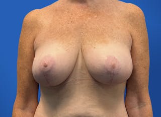 Breast Lift Before & After Gallery - Patient 117765 - Image 6