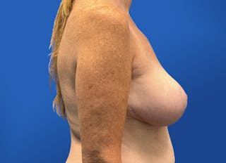 Breast Lift Before & After Gallery - Patient 117765 - Image 10