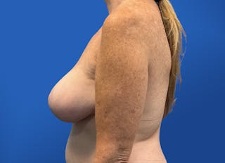 Breast Lift Before & After Gallery - Patient 117765 - Image 2