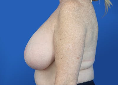 Breast Lift Before & After Gallery - Patient 117765 - Image 1