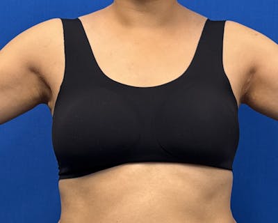 Axillary Breast Removal Before & After Gallery - Patient 147843 - Image 2