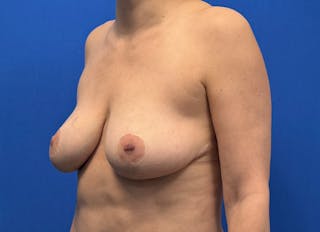 Breast Reduction Before & After Gallery - Patient 161587 - Image 4