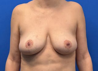 Breast Reduction Before & After Gallery - Patient 161587 - Image 6