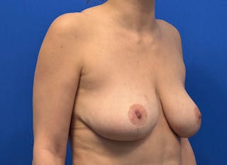 Breast Reduction Before & After Gallery - Patient 161587 - Image 8