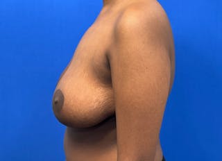 Breast Reduction Before & After Gallery - Patient 303053 - Image 2