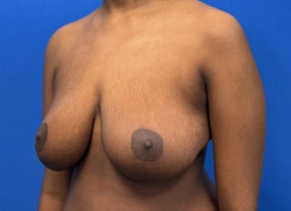 Breast Reduction Before & After Gallery - Patient 303053 - Image 4