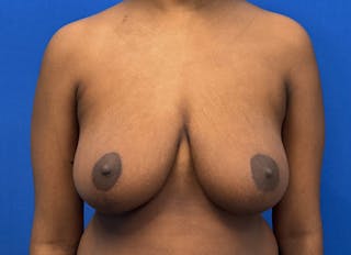 Breast Reduction Before & After Gallery - Patient 303053 - Image 6