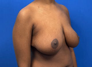 Breast Reduction Before & After Gallery - Patient 303053 - Image 8
