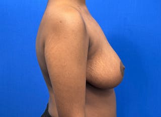 Breast Reduction Before & After Gallery - Patient 303053 - Image 10