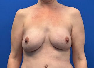 Hybrid Reconstruction Gallery Before & After Gallery - Patient 112338052 - Image 6