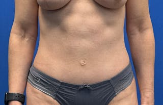Abdominoplasty Before & After Gallery - Patient 112338682 - Image 6