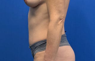 Abdominoplasty Before & After Gallery - Patient 112338682 - Image 2