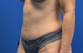 Abdominoplasty Before & After Gallery - Patient 112338682 - Image 4