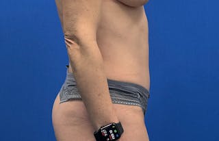 Abdominoplasty Before & After Gallery - Patient 112338682 - Image 10