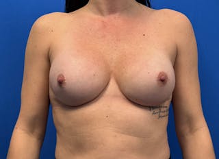 Implant Reconstruction Gallery Before & After Gallery - Patient 241844 - Image 6
