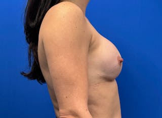 Implant Reconstruction Gallery Before & After Gallery - Patient 241844 - Image 10