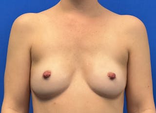 Hybrid Reconstruction Gallery Before & After Gallery - Patient 179250603 - Image 6