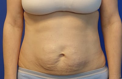 Abdominoplasty Before & After Gallery - Patient 445970 - Image 5