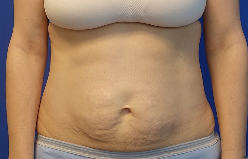 Abdominoplasty Before & After Gallery - Patient 445970 - Image 5