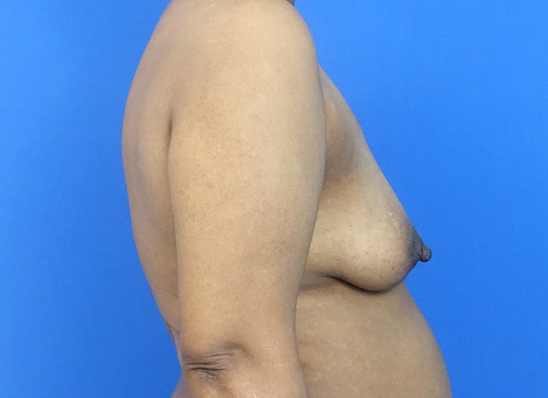 Flap Reconstruction Gallery Before & After Gallery - Patient 229792 - Image 9