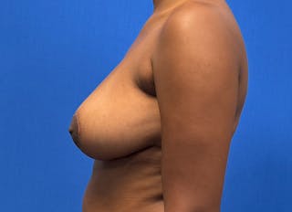 Breast Reduction Before & After Gallery - Patient 359699 - Image 2