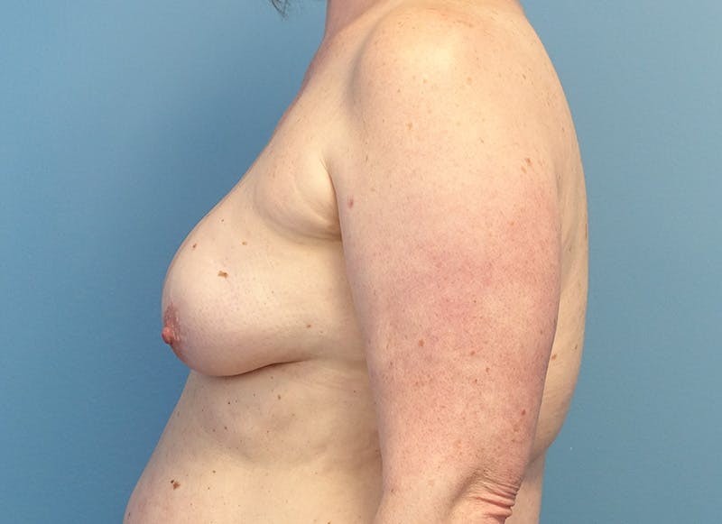 Flap Reconstruction Gallery Before & After Gallery - Patient 415135 - Image 1